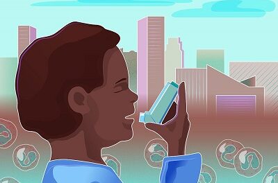 Monoclonal antibody reduces asthma attacks in urban youth