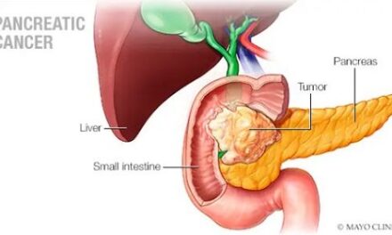 Staging pancreatic cancer early with minimally invasive surgery shows positive results in patient prognosis, Mayo Clinic study finds