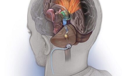 Cerebellar post-stroke deep brain stimulation appears safe and feasible in a small trial