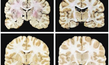 CTE identified in brain donations from young amateur athletes
