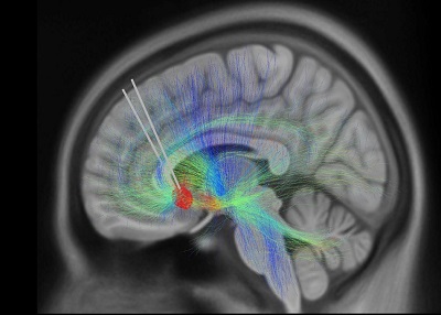 Researchers discover biomarker for tracking depression recovery