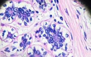 Cleveland Clinic Research Reveals How Breast Cancer Gene Mutations May Impact Cell Communication