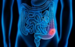 Cleveland Clinic Research Reveals Unique Tumor-Related Bacteria Tied to Young-Onset Colorectal Cancer