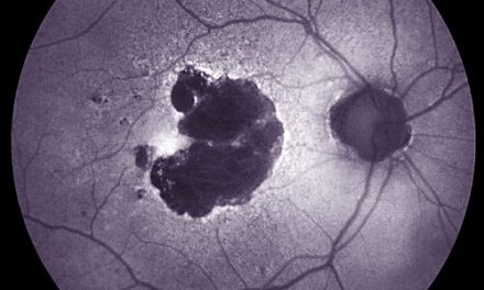 Inflammation-reducing drug shows no benefit for dry age-related macular degeneration in NIH trial
