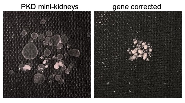 Scientists discover potential treatment approaches for polycystic kidney disease
