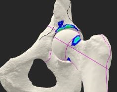 New Study from HSS Reveals Minimally Invasive Procedure Can Delay Arthritis in Select Patients with Hip Impingement