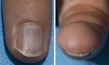 Benign nail condition linked to rare syndrome that greatly increases cancer risk