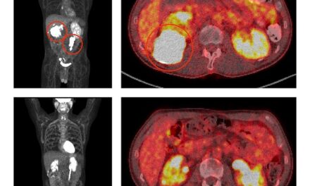 Combination targeted treatment produces lasting remissions in people with resistant aggressive B-cell lymphoma