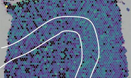 Scientists identify genes linked to brain cell loss in ALS