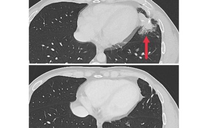 Immunotherapy approach shows potential in some people with metastatic solid tumors