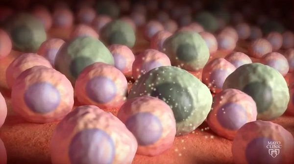 Drugs that kill “zombie” cells may benefit some older women, but not all, Mayo Clinic study finds