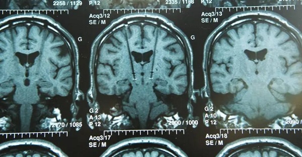 Expert alert: Surgical approaches being studied to restore function after stroke