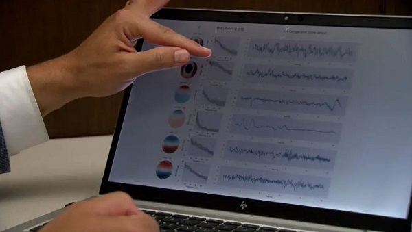 AI boosts the power of EEGs, enabling neurologists to quickly, precisely pinpoint signs of dementia