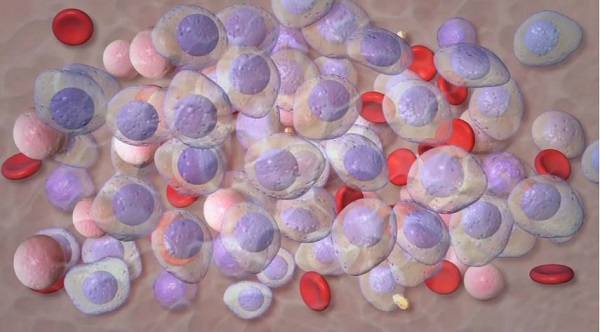 As blood cancer treatments evolve, so does the patient journey