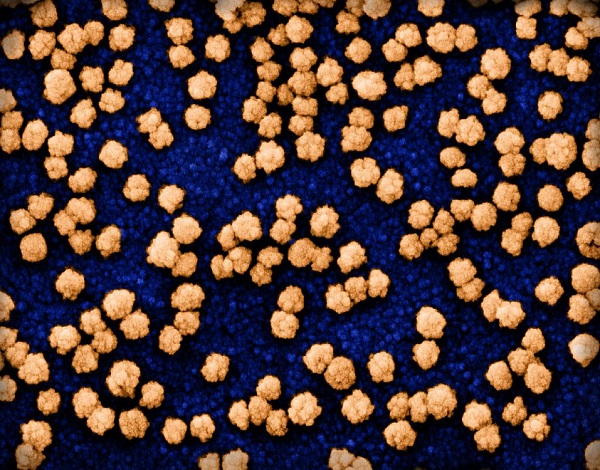 First wave of COVID-19 increased risk of heart attack, stroke up to three years later