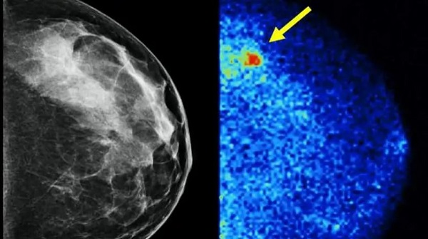 Mayo Clinic Health System discusses advancements in breast cancer screenings
