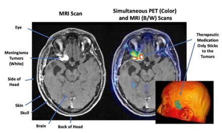 Radiopharmaceutical therapy shows favorable results for people with tough-to-treat meningioma brain tumors, Mayo Clinic study finds