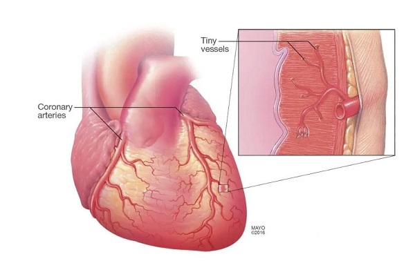 Hourglass-shaped stent could ease severe chest pain from microvascular disease
