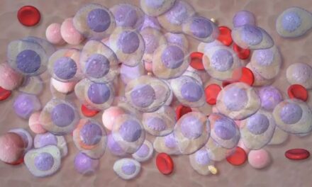 Research shows new treatment could delay cancer progression in patients with high-risk smoldering multiple myeloma