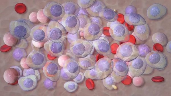 Research shows new treatment could delay cancer progression in patients with high-risk smoldering multiple myeloma