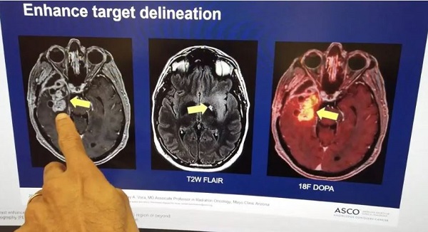 Breakthrough in treatment approach showing promise in the fight against glioblastoma, the deadliest and most aggressive type of brain cancer