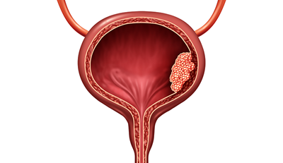 Advancements in Bladder Cancer Treatment: Memorial Healthcare System Leads the Way in Innovative Care and Patient Outcomes