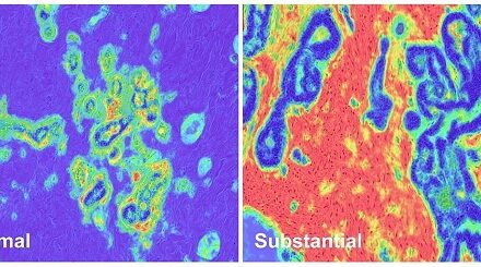 NIH researchers discover tissue biomarker that may indicate higher risk of aggressive breast cancer development and death