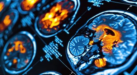 Newer Brain Scans Helping Doctors Detect, Treat Different Types of Dementia Earlier