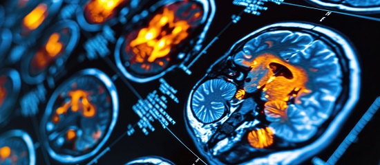 Newer Brain Scans Helping Doctors Detect, Treat Different Types of Dementia Earlier