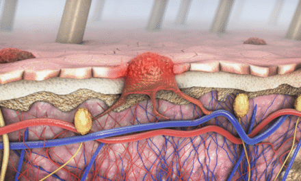 New genomic test could spare some people with melanoma from lymph node biopsy surgery