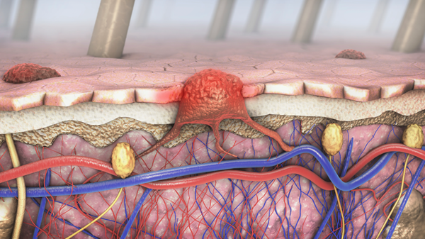 New genomic test could spare some people with melanoma from lymph node biopsy surgery