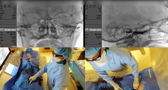 MEMORIAL BROADCASTS NEUROINTERVENTIONAL PROCEDURES TO GLOBAL AUDIENCES