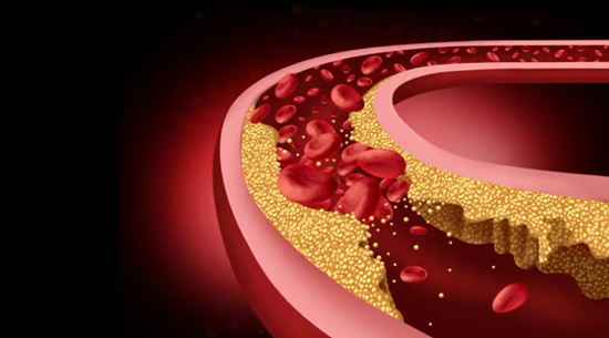 Cleveland Clinic First-In-Human Trial of CRISPR Gene-Editing Therapy Shown to Safely Lower Cholesterol and Triglycerides