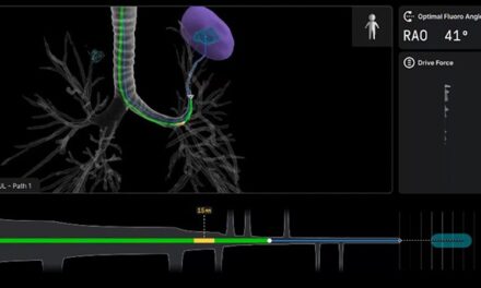 The Pursuit of Earlier Diagnosis – Robotic-Assisted Bronchoscopy Reshapes Early Lung Cancer Management