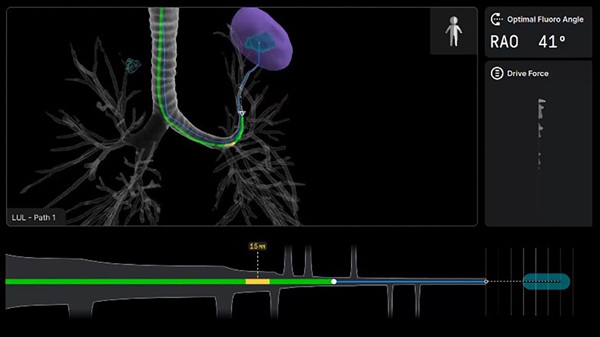 The Pursuit of Earlier Diagnosis – Robotic-Assisted Bronchoscopy Reshapes Early Lung Cancer Management