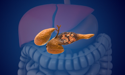 Mayo Clinic AI detects pancreatic cancer up to 3 years before diagnosis in landmark validation study