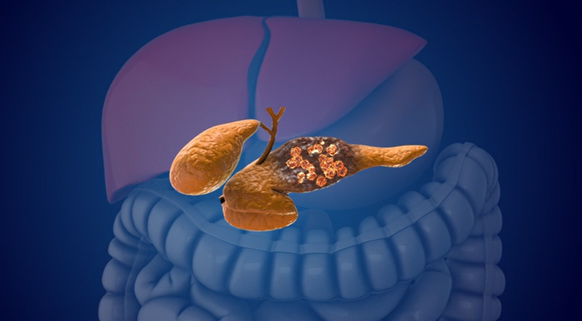 Mayo Clinic AI detects pancreatic cancer up to 3 years before diagnosis in landmark validation study - Florida Hospital News and Healthcare Report