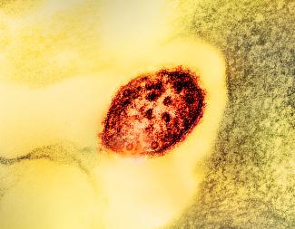 Researchers identify first suite of human antibodies against measles virus