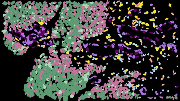 Spatial map of bladder cancer reveals hidden tumor environments and new paths toward precision therapy