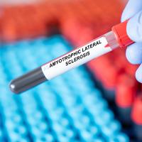 NIH: New blood-based biomarkers predict when ALS symptoms will emerge