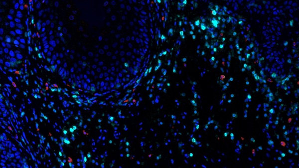 MD Anderson : Early inflammation signal drives oral cancer development, highlights path for immunoprevention