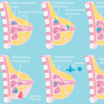 MAYO : Inflammatory breast cancer: Fast-moving form often lacks lump as warning sign
